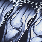 Knee MRI showing damage of cross-shaped ligaments